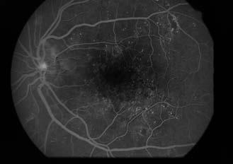 A diabéteszes maculopathia diagnosztikája és kezelése 5. ábra: Nagy felbontású felvételen a centrális retina megvastagodása figyelhető meg.