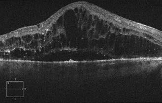 A neu - roepithelium elemelkedése valamelyest csökkent, de nem szűnt meg, a neuroepithelium szerkezete nem vehető ki. A beteg szubjektív panaszai, torzlátása csökkent, látásélessége 0,15-ra javult.