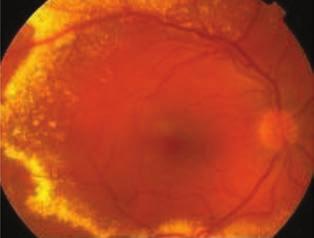 Coats Disease of adult onset BEVEZETÉS A Coats-betegség a retina érhálózatának teleangiectatikus tágulatával, intra- és subretinalis exsu datióval járó ritka elváltozása (12, 15, 22, 23).