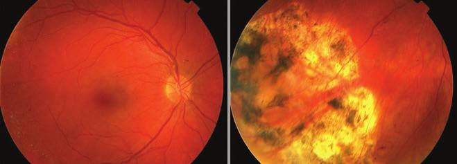 Tempo rálisan alul az alsó érárkádot megközelítően vaskos li - pid exsudatio, kiterjedt serosus retinaleválás volt megfigyelhető (7. áb - ra.).