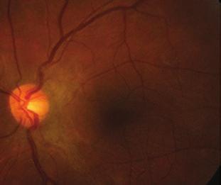 Coats Disease of adult onset 9. ábra: A 2. beteg bal szemének fundusképe a műtétet követően egy évvel. A hátsó póluson epiretinalis membrán látható 10. ábra: A 2. beteg bal szemének perifériás fun - dusképe (alsó tem po ra - lis retinafél) a műtétet követően egy évvel 11.