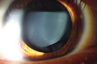 Combined cataract surgery on a marfan-syndrome patient Case report 1.