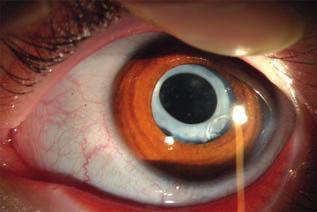 Kombinált szürkehályog-műtét Marfan-szindrómás betegnél Esetismertetés 3. ábra: Hat hónappal a műtét után, pupillatágítást követően készült réslámpa felvétel a bal szemről.