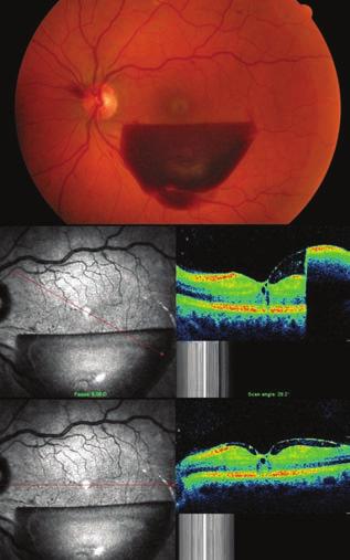 Valsalva retinopathy treated with laser membranotomy Case report 1.