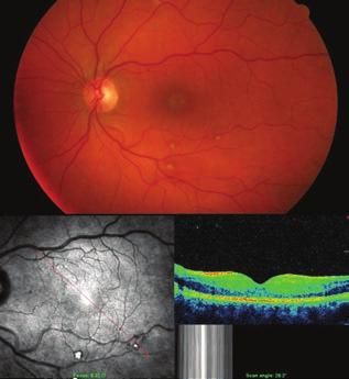 Valsalva retinopathia kezelése lézer membranotómiával Esetismertetés 3.