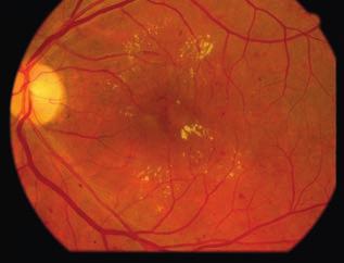 Management of diabetic macular edema 1. ábra: Klinikailag szig - nifikáns maculaödéma színes szemfenéki fotója.