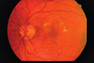 A kemény exsudátumok megközelítik az avascularis zóna centrumát néki türközéssel a retina megvastagodása nem határozható meg, ezért ezek a módszerek a diabéteszes maculopathia vizsgálatára