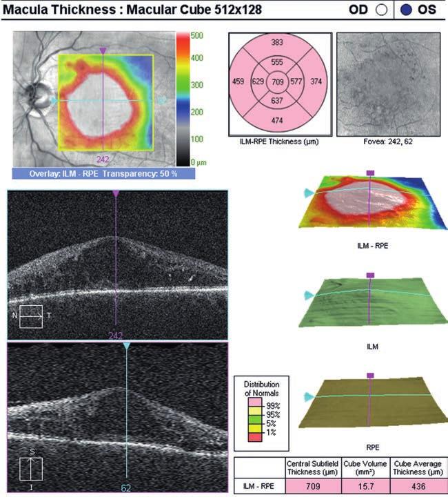 Ezek a készülékek a macula volumen pontos meghatározásán kívül lehetővé teszik a centrális fotoreceptor-károsodás mértékének pontos értékelését.