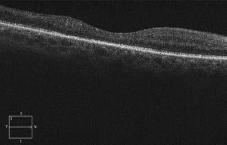 B: Nagy felbontású OCT-felvételen a neuroepithelium szerkezete teljesen elmosódott, a pigmentepithelium és a fotoreceptor-réteg jól kivehető.