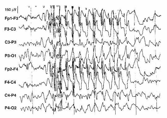 Figure 1. The figure represents a typical absence seizure with 3-Hz spike-wave discharges.