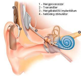 A felerősített hang vezetődik tovább a fülben. Hallókészülék típusok (balról): hallójárati ~ (1-3; max.