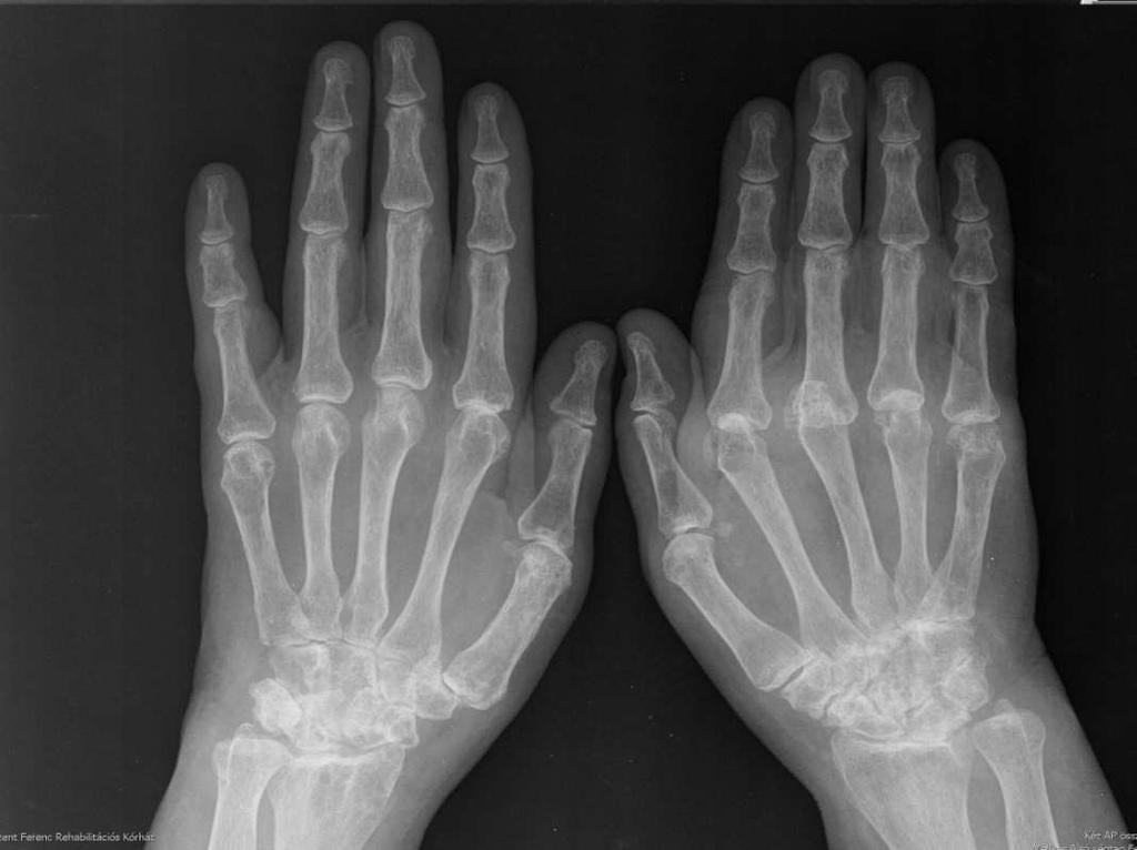 A beteg utolsó képe 2 évvel később 26.) ábra: Összehasonlító kéz röntgenfelvétel AP irányban. A kéz csontjainak mésztartalma csökkent. Baloldalon a II. MCP ízületi rések szűkebbek, a II-IV.