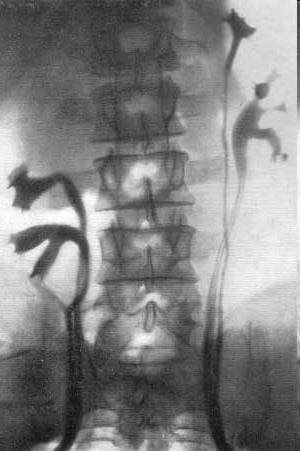 Vesicoureteralis reflux (VUR)