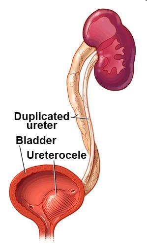 duplex, ectopia -diverticulum