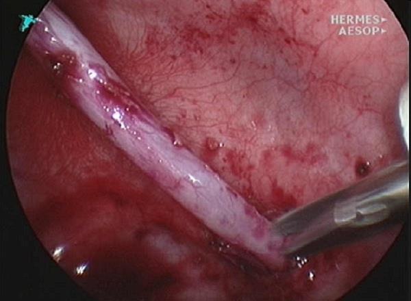 Húgyúti fertőzések, VUR VUR kezelése II. - ureter neiomplantatio (súlyos: gr.
