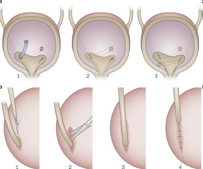 Ureter