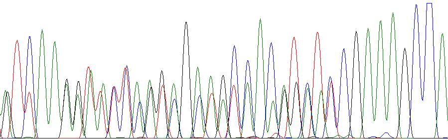 ábra, A). A FISH vizsgálat az EGFR gén amplifikációját mutatta (12. ábra, B).