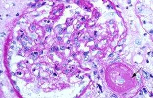 Scleroderma vese krízis Diffúz cutan SSc 5-20 %-ában jelentkezik a betegség első 5 évében Kockázati tényezők: diffúz bőrtünetek, inak feletti dörzszörejek nagy adag kortikoszteroidkezelés Anti RNS