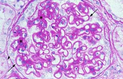 A nephrosis syndromát okozó SLE jellemzői Az SLE nephritis 10-20%-a.