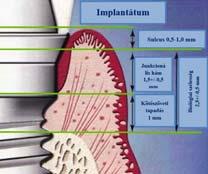 Parodontitis. Implantációt befolyásoló faktor? 1. KÉRDÉSFELVETÉS Független-e az implantátum sikeressége a parodontitisztől?