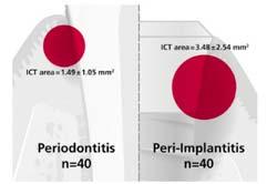 Difference in the size of the inflammatory connective tissue (ICT) infiltrate of 40 human biopsies of teeth with chronic periodontitis and 40 human biopsies of implants with