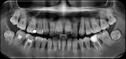 3. KÉRDÉSFELVETÉS Van-e különbség Agresszív parodontitis esetén? A BIZONYÍTÉKOK PIRAMISA 10Y 2Y!