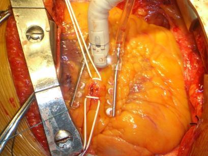 hypoperfúzió kockázata aorta kirekesztése speciális