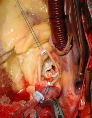 aortaív műtétek aneurysmectomia, aneurysma-plicatio szívátültetés és alternatívái pacemaker