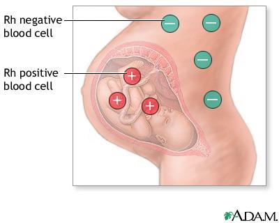 Rh negatív vérsejt Rh pozitív vérsejt Az Rh Inkompatibilitás Ellenanyag (IgG) Megelőzés és