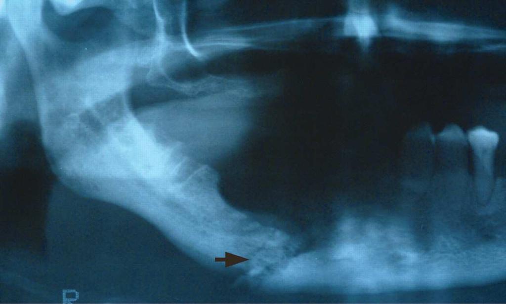 Orthopantomogram showing extensive bisphosphonate induced osteonecrosis of the jaw in the right body of the mandible.