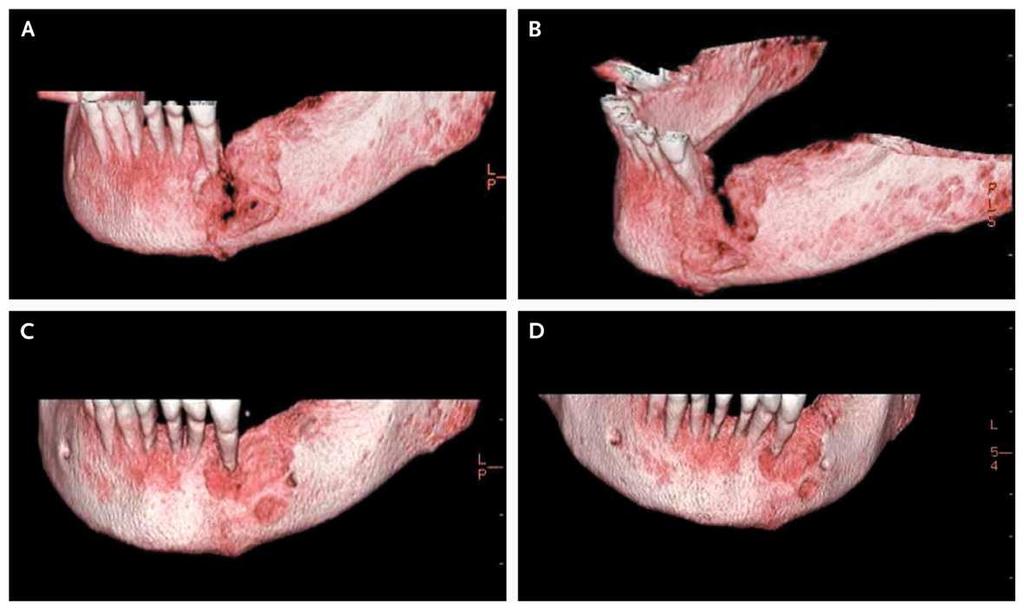 Computed Tomographic Reconstruction of Osteonecrosis of the Jaw in an