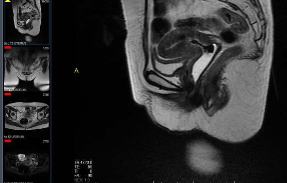 nyirokcsomó status PET/CT: lokális