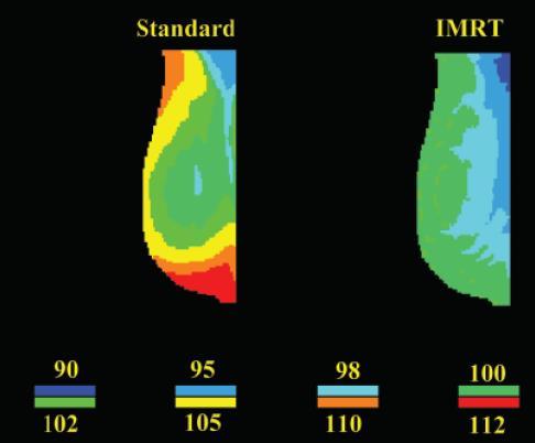 IMRT-IGRT