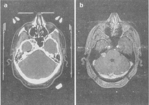 Sztereotaxia CT scan MRI