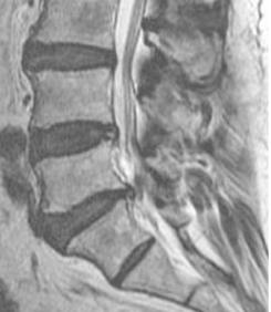 benignómák(meningeoma, neurinoma )