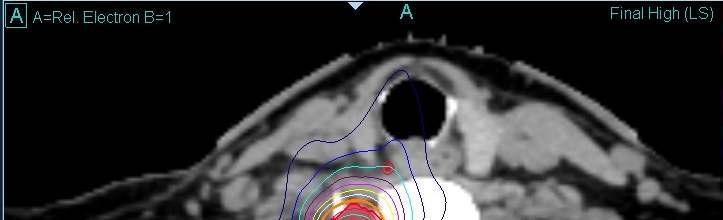 Gerinc meningeoma