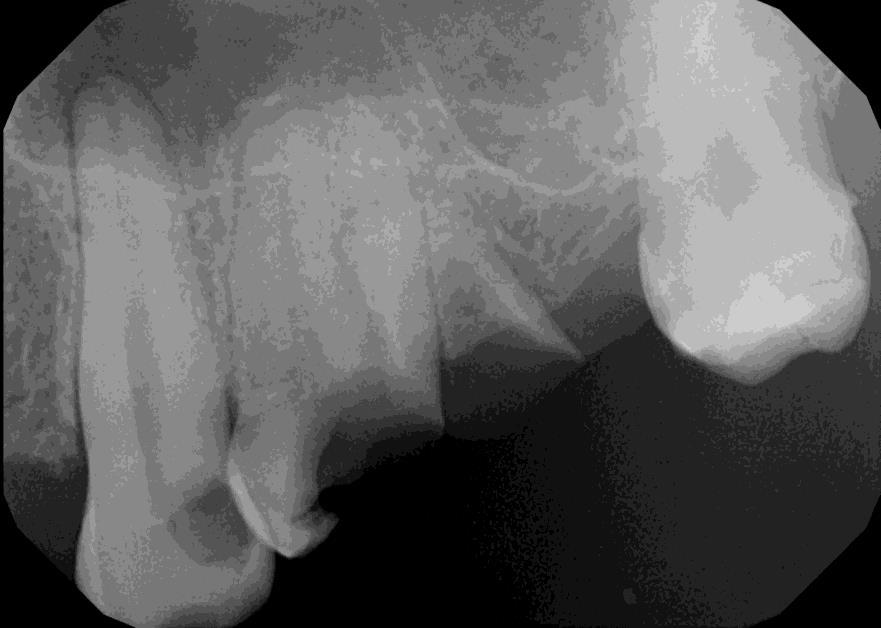 Ambuláns beavatkozás: Panaszos fogak vizsgálata Inspekció:24,25 radi Palpáció: 24,25 erős pozitivitást mutat (szomszédos fogakhoz viszonyítva) Perkusszió: 24,25 erős pozitivitást mutat (szomszédos