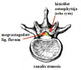 Lumbalis canalis spinalis anatómiai variációk Kerek Ovoid Szűk Spondylogén (nem