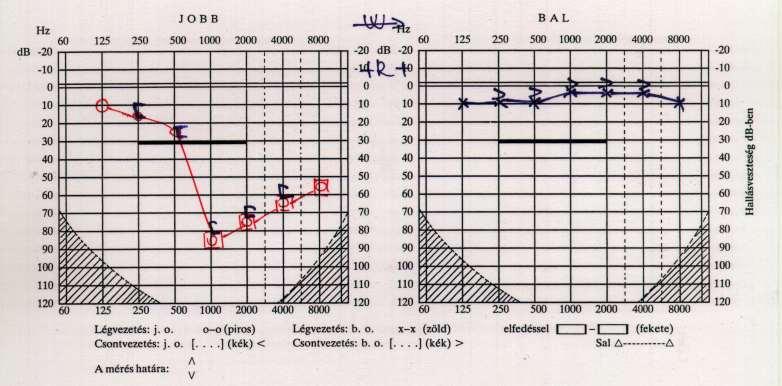 Audiogram Kis, közepes,