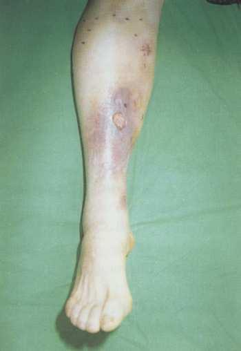 A vénás eredető lábszárfekélyes betegek 60%-ánál (12 eset) a kenıcs alkalmazását a keringést rendezı, helyreállító érmőtét elızte meg.