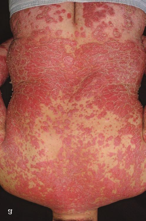 TNF-α gátlók Plakkos psoriasis kezelésére elérhető TNF-gátló szerek Magyarországon jelenleg az infliximab, az adalimumab, az etanercept és a certolizumab pegol.