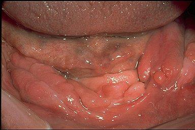 gingiva hyperplasia AD, gingiva (+ mental retardatio, epilepsia -az oralis mucosa lokális duzzanata -hegszövet+ fibroblastok+/-chronicus (lymphocytás) gyulladás