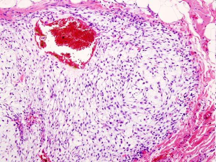 Malignus mesenchymalis tumorok: porctumorok Chondrosarcoma: -kevésbé gyakoribb, mint az