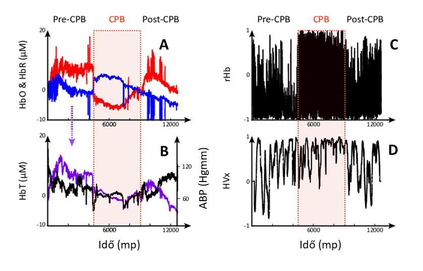 Hemoglobin (g/dl) 9,4 1,5 Az eredmények átlag ± SD vagy medián és interquartilis range-ként vannak feltüntetve; SvO2 = kevert vénás oxigén szaturáció. 1. ábra A nyers és számított NIRS paraméterek egy alanyból származó reprezentatív idősorai szívműtét alatt.