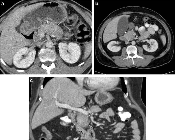 Képalkotó diagnosztika CECT: a) AIP diffúz megnagyobbodás b) AIP fokális megnagyobbodás c) Fokális pancreas fej érintettség Insights