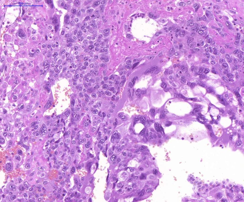 GESZTÁCIÓS CHORIOCARCINOMA komplett mola (50%) vetélés (25%) normál