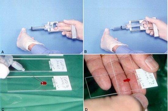 ASPIRÁCIÓS CITOLÓGIA FNAB/FNAC: fine needle aspiration biopsy/cytology