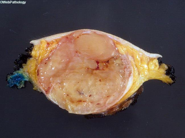 PHYLLOID TUMOR 40-50