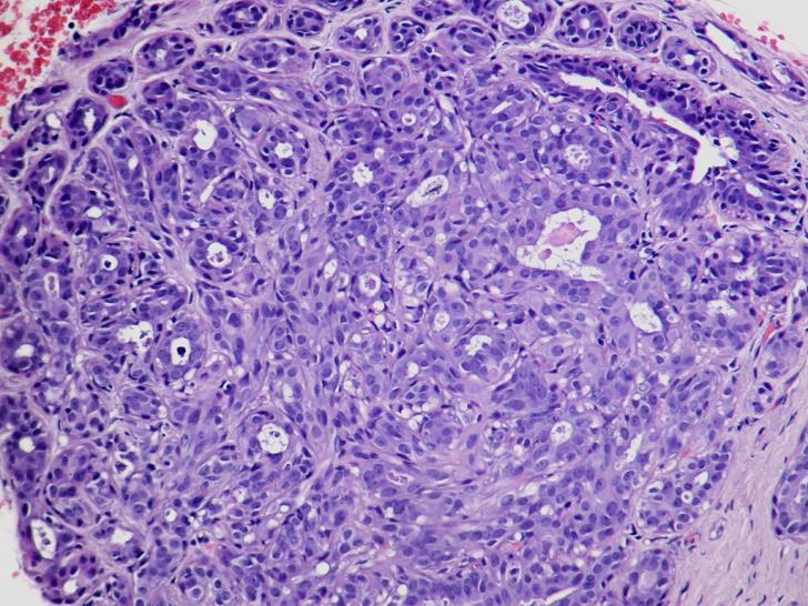 hyperplasia Proliferatív elváltozások atípiával Atípusos