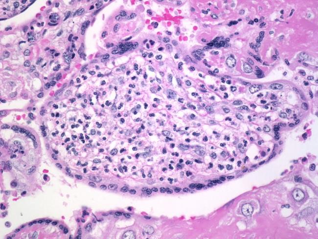 burokrepedéshez társul Szövődmények Chorioamnionitis Funisitis Villitis Neonatalis sepsis https://librepathology.